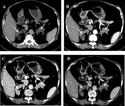 Case report: A 51-year-old diabetic patient with primary bilateral macronodular adrenal hyperplasia and primary hyperparathyroidism